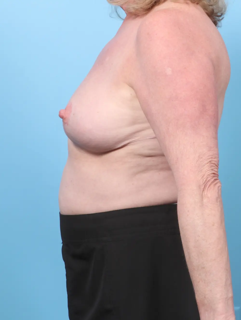 Breast Implant Revision Patient Photo - Case 59243 - after view-2