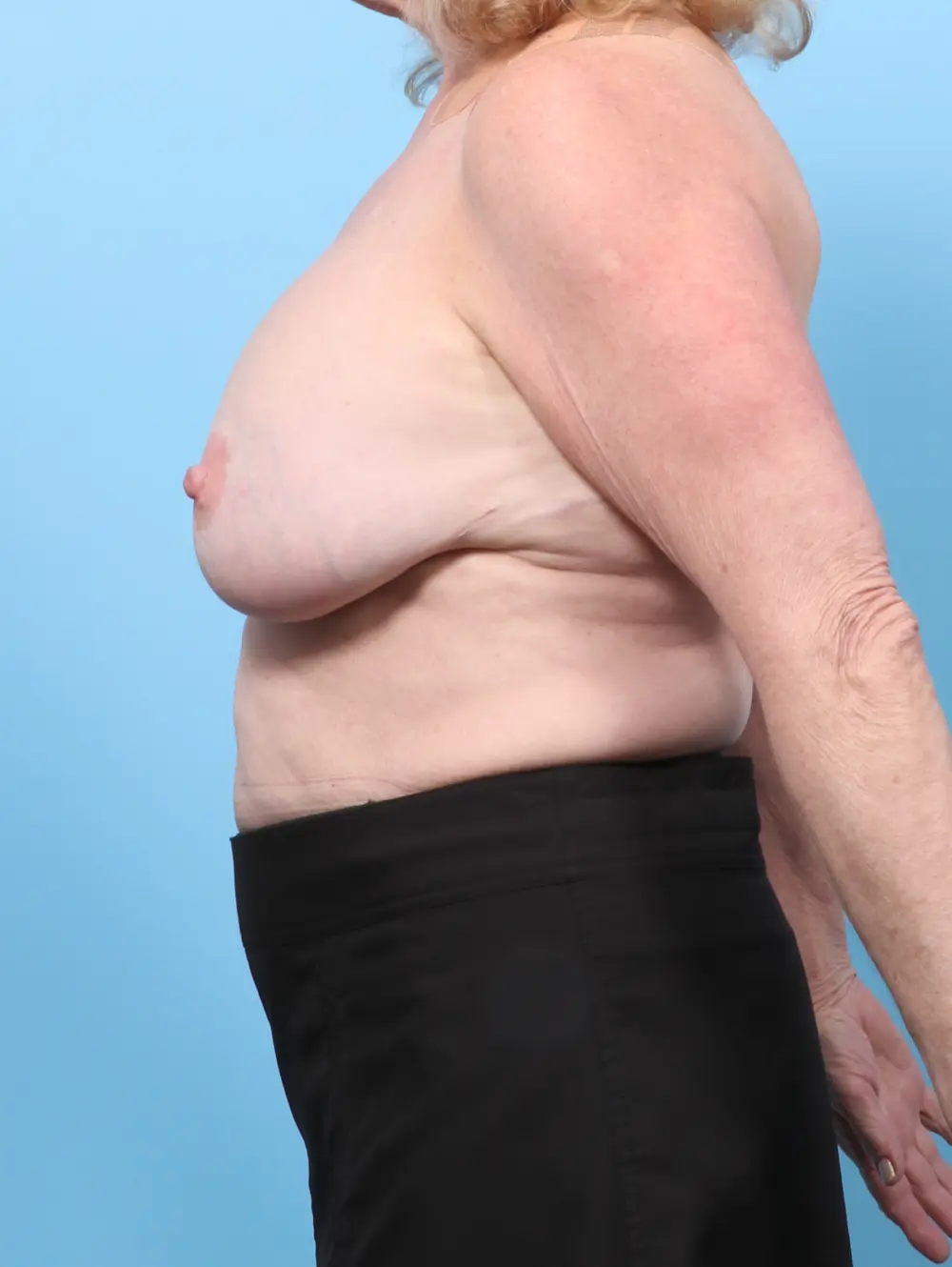 Breast Implant Revision Patient Photo - Case 59243 - before view-2