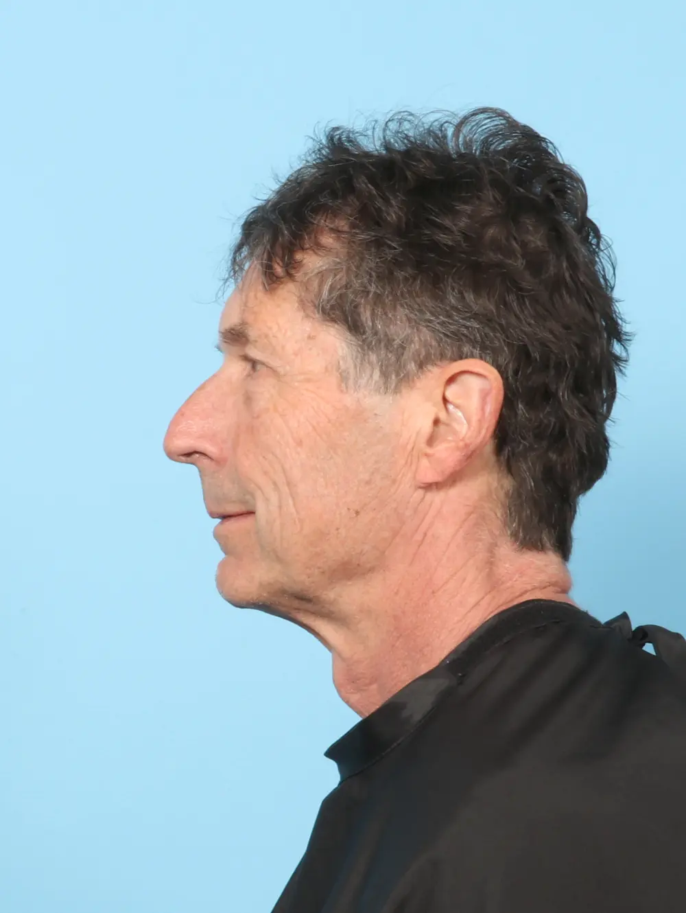 Eyelid Surgery Patient Photo - Case 59254 - before view-2