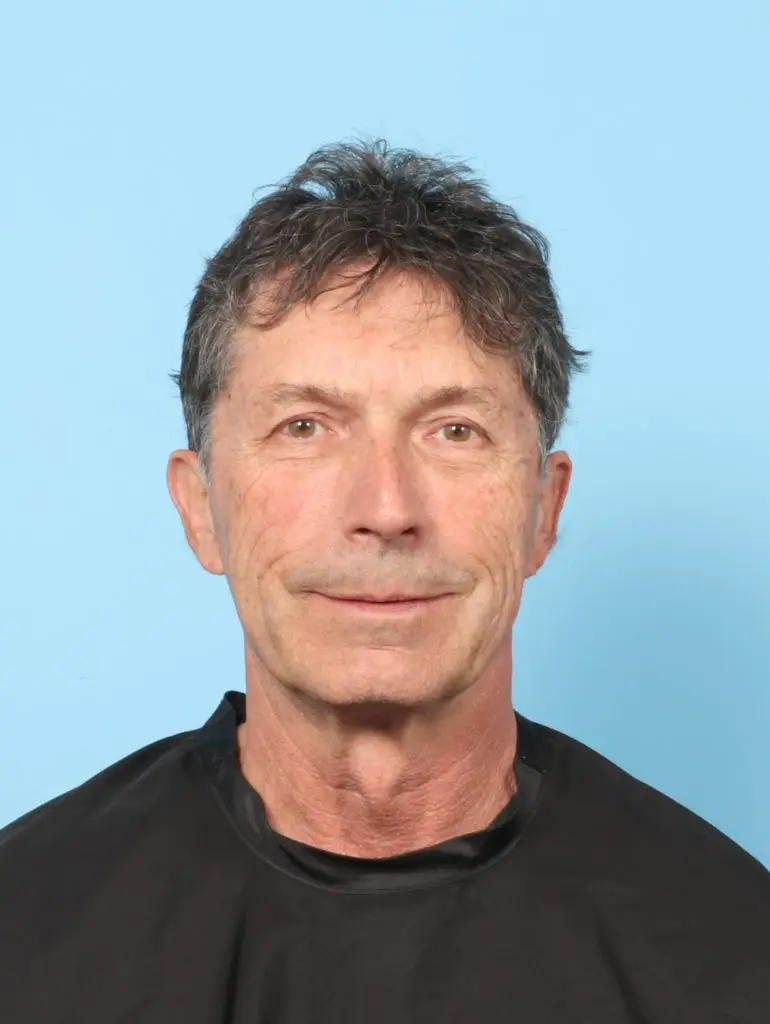 Eyelid Surgery - Case 59254 - Before