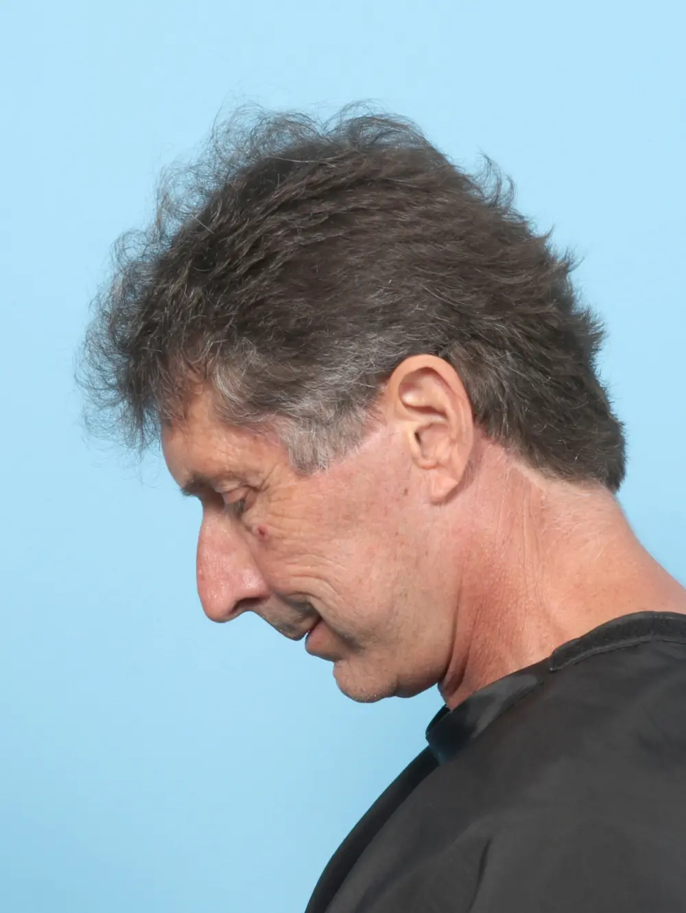 Eyelid Surgery Patient Photo - Case 59254 - after view-3