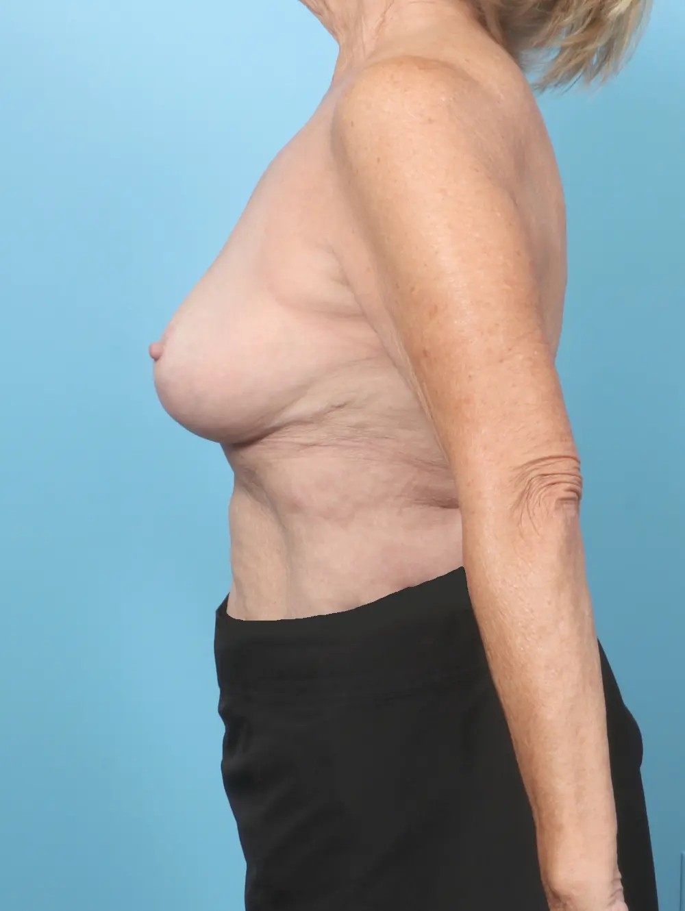 Breast Lift/Reduction w/o Implants Patient Photo - Case 59264 - after view-2
