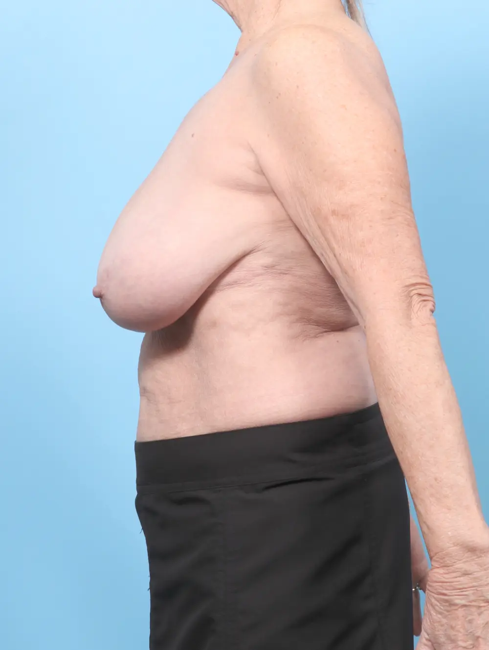 Breast Lift/Reduction w/o Implants Patient Photo - Case 59264 - before view-2
