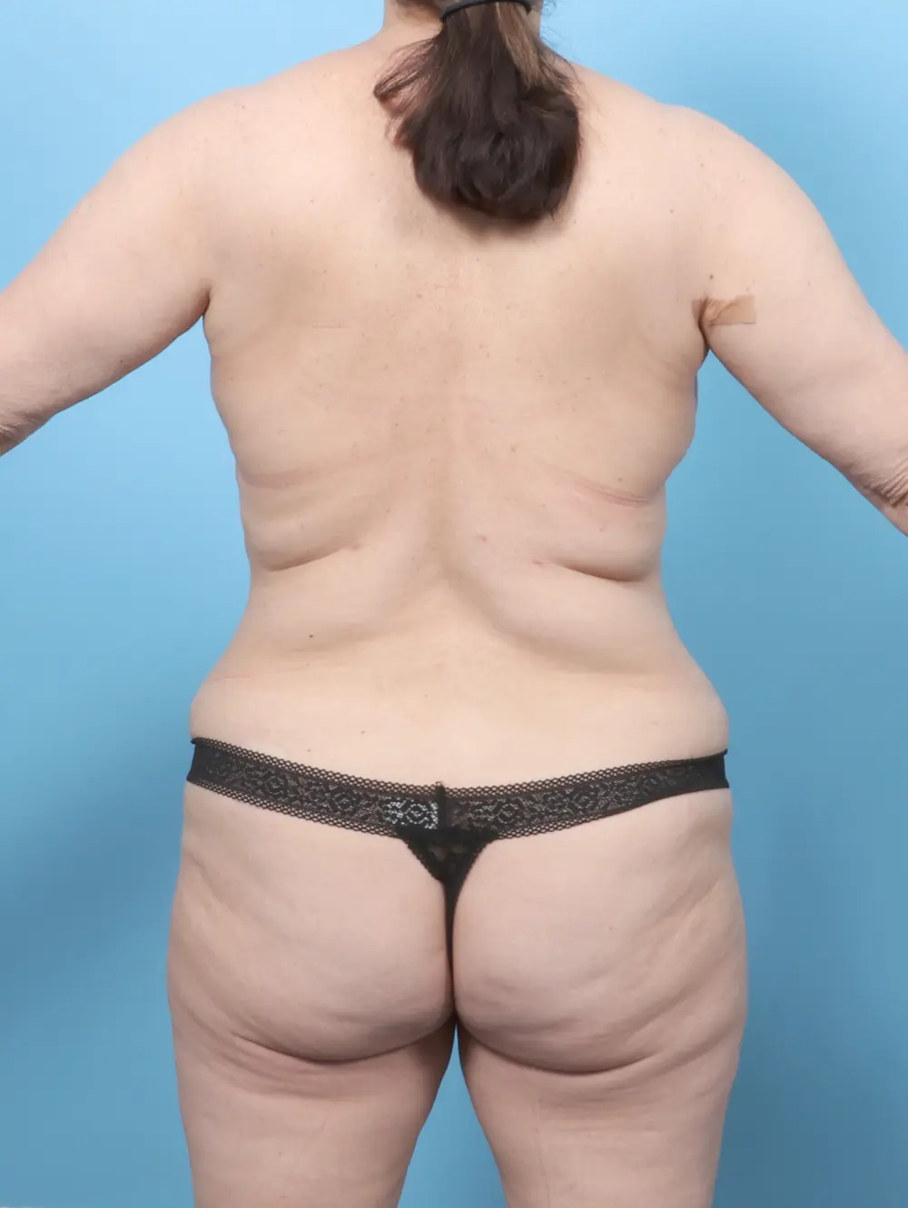 Breast Lift/Reduction w/o Implants Patient Photo - Case 59290 - after view-3