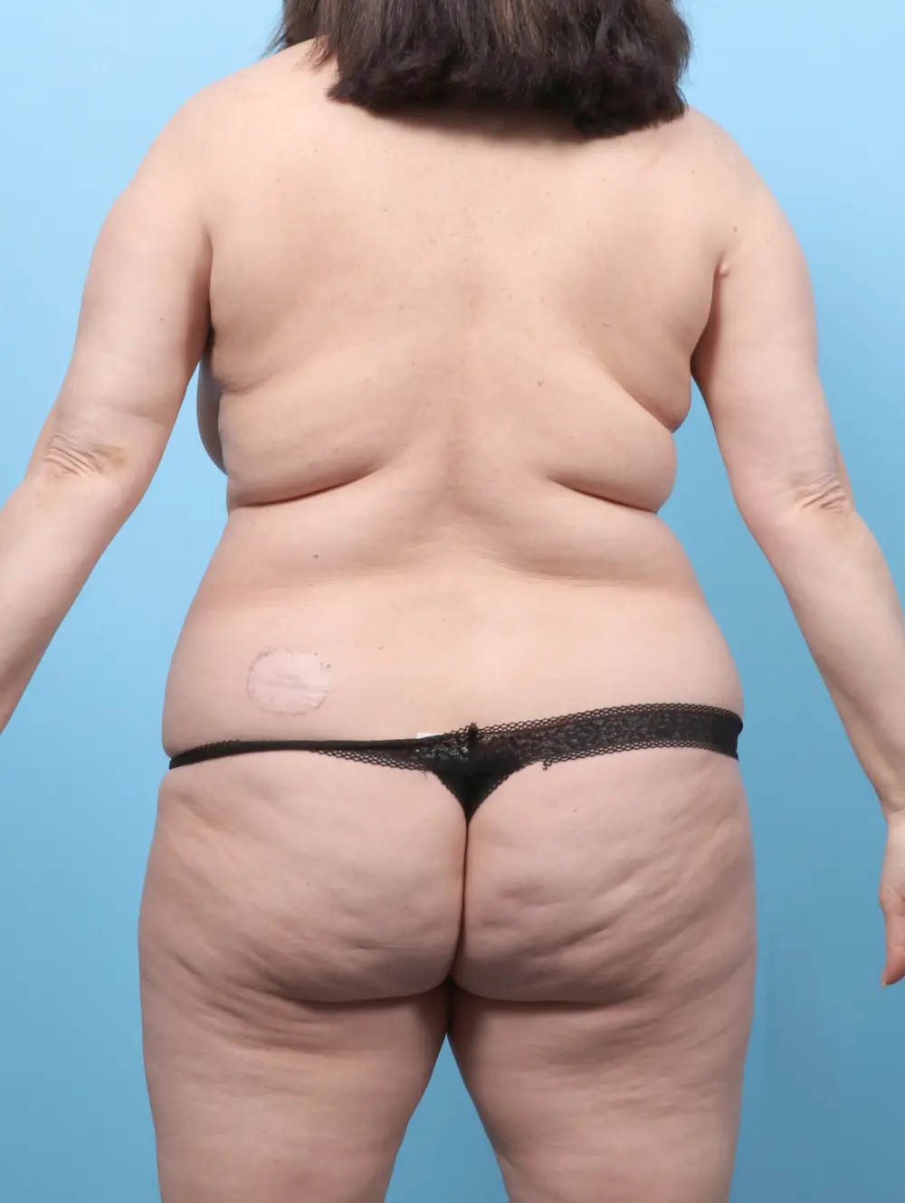 Breast Lift/Reduction w/o Implants Patient Photo - Case 59290 - before view-3