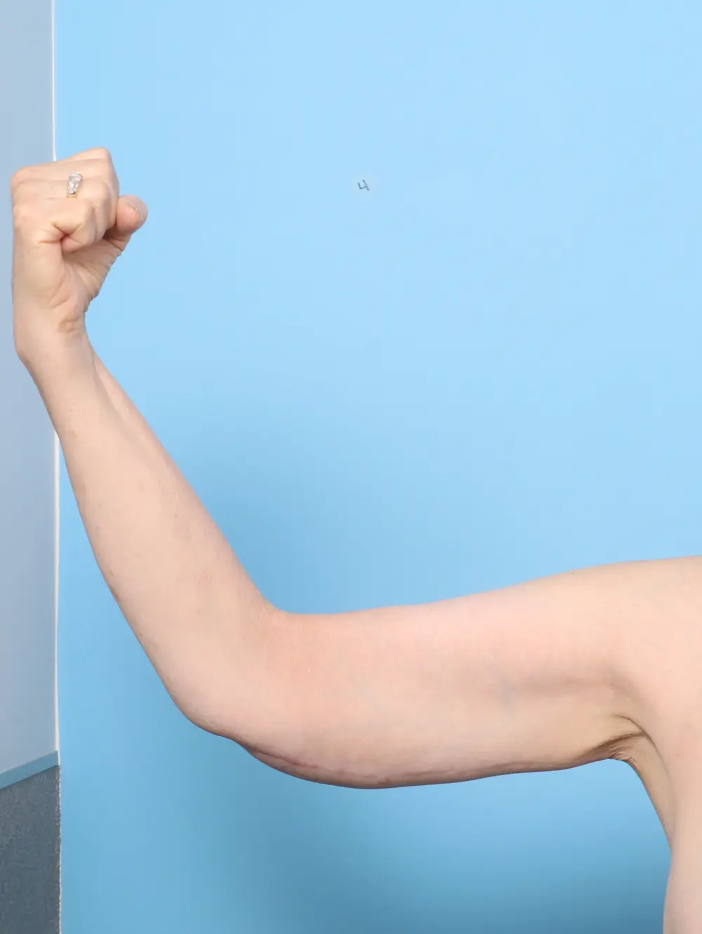 After Weight Loss Patient Photo - Case 59380 - after view-1