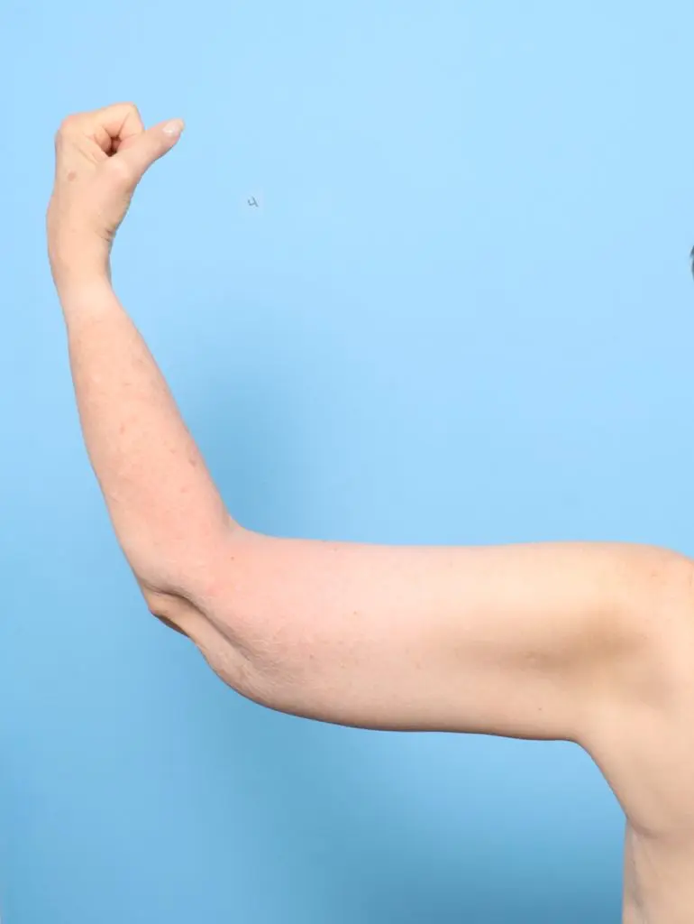 After Weight Loss - Case 59380 - After