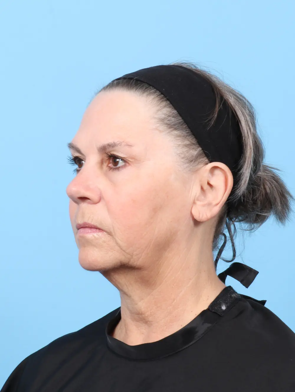 Facelift / Neck Lift Patient Photo - Case 59386 - before view-1