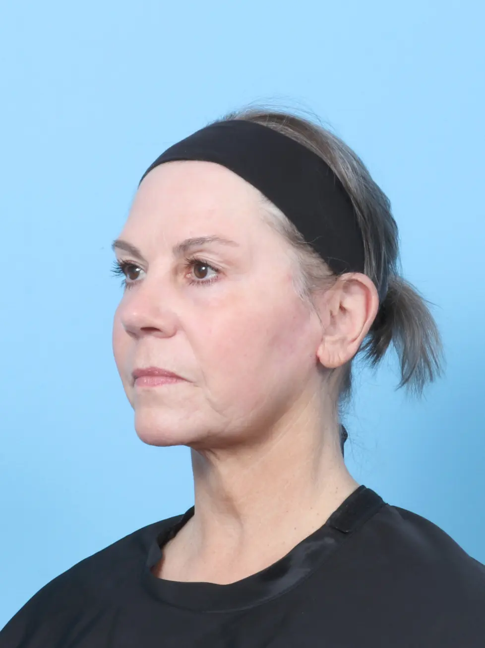 Facelift / Neck Lift Patient Photo - Case 59386 - after view-1
