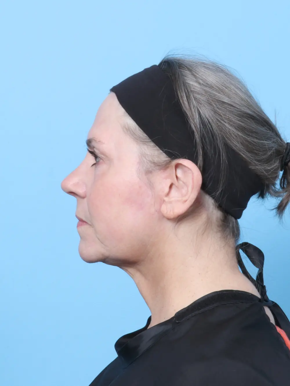 Facelift / Neck Lift Patient Photo - Case 59386 - after view-2