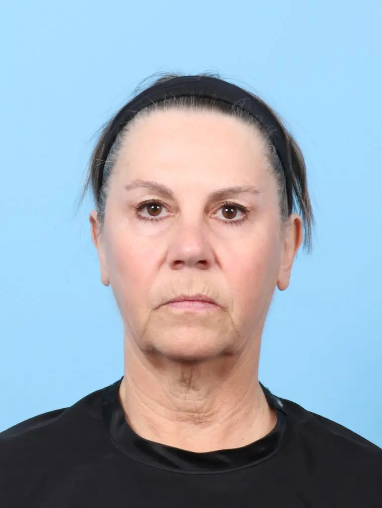 Facelift / Neck Lift - Case 59386 - Before