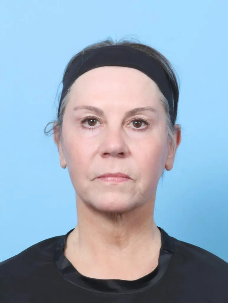 Facelift / Neck Lift - Case 59386 - After