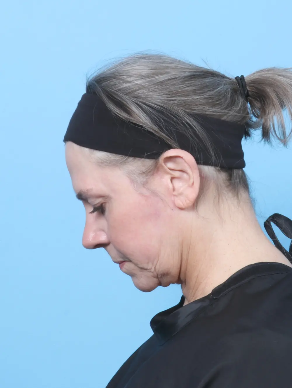 Facelift / Neck Lift Patient Photo - Case 59386 - after view-3