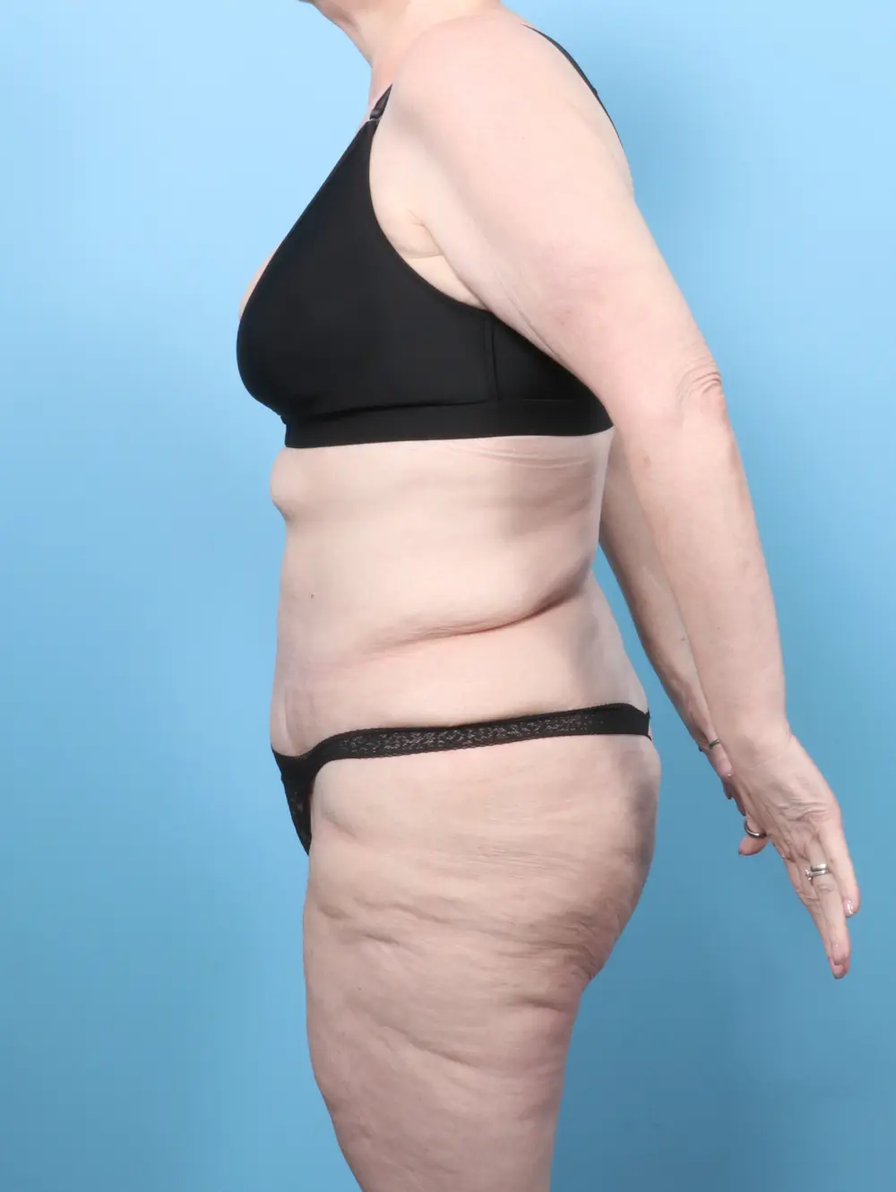 After Weight Loss Patient Photo - Case 59397 - after view-2