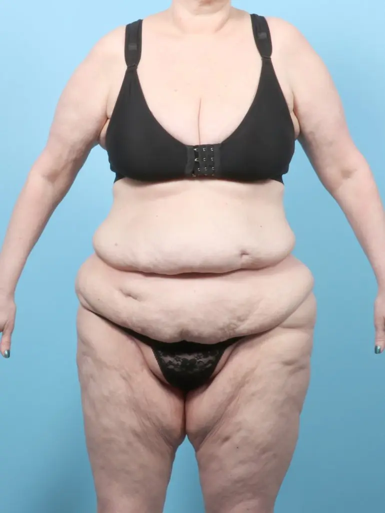 After Weight Loss - Case 59397 - Before