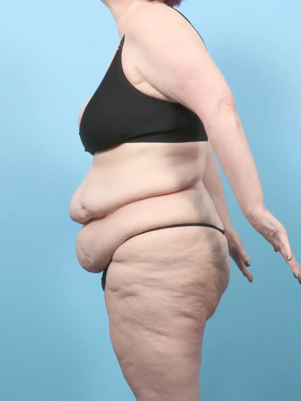 After Weight Loss Patient Photo - Case 59397 - before view-2