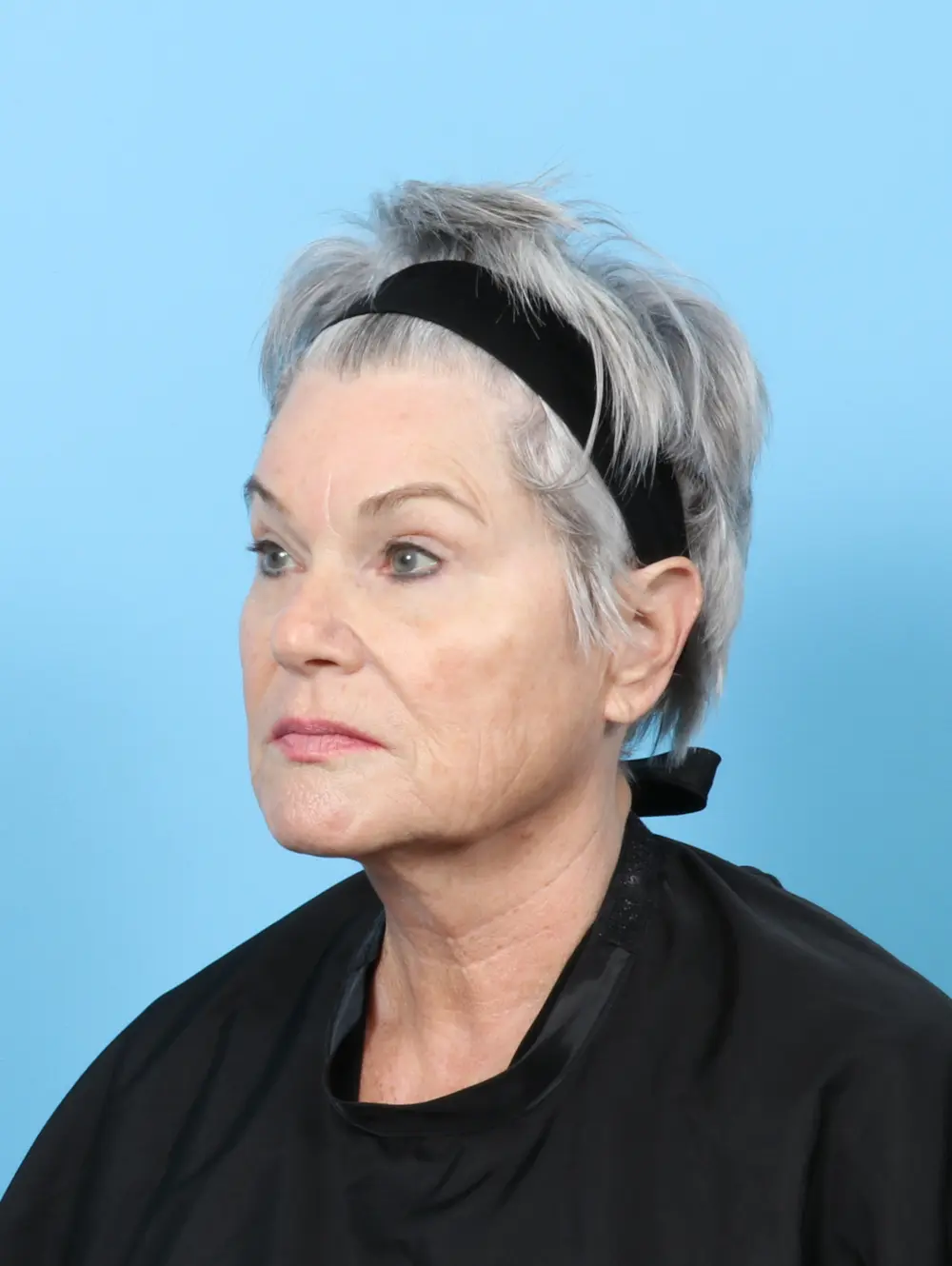 Facelift / Neck Lift Patient Photo - Case 59405 - before view-1