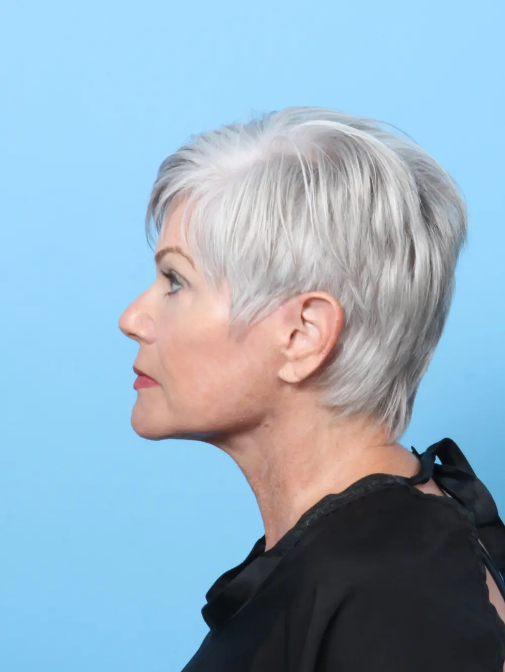 Facelift / Neck Lift Patient Photo - Case 59405 - after view-2