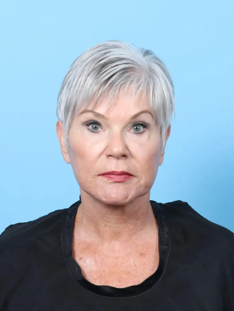 Facelift / Neck Lift - Case 59405 - After