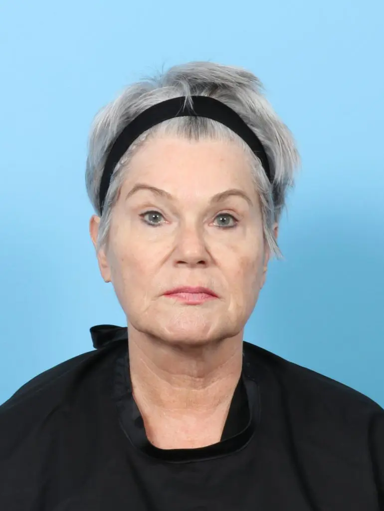 Facelift / Neck Lift - Case 59405 - Before