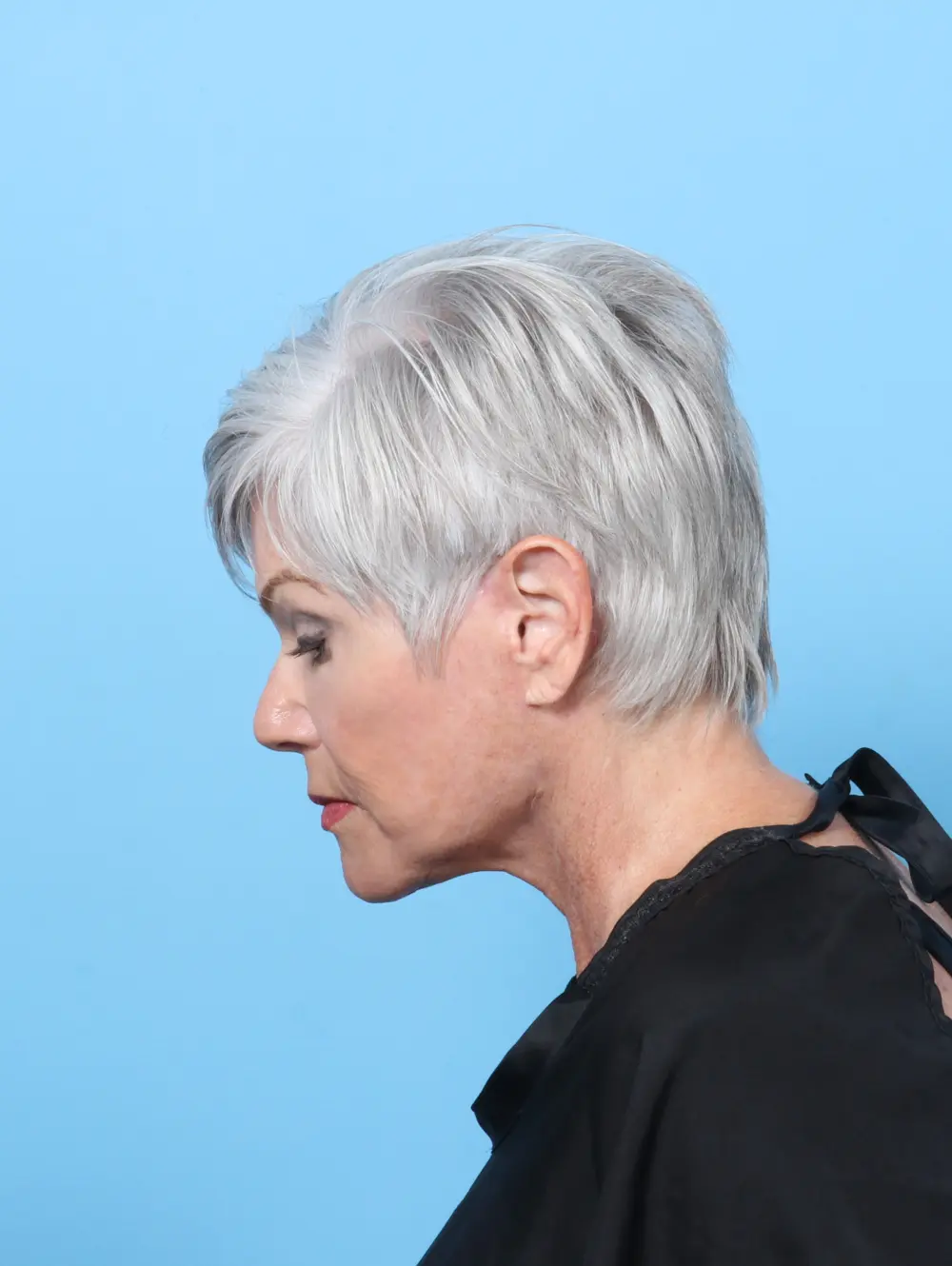 Facelift / Neck Lift Patient Photo - Case 59405 - after view-3