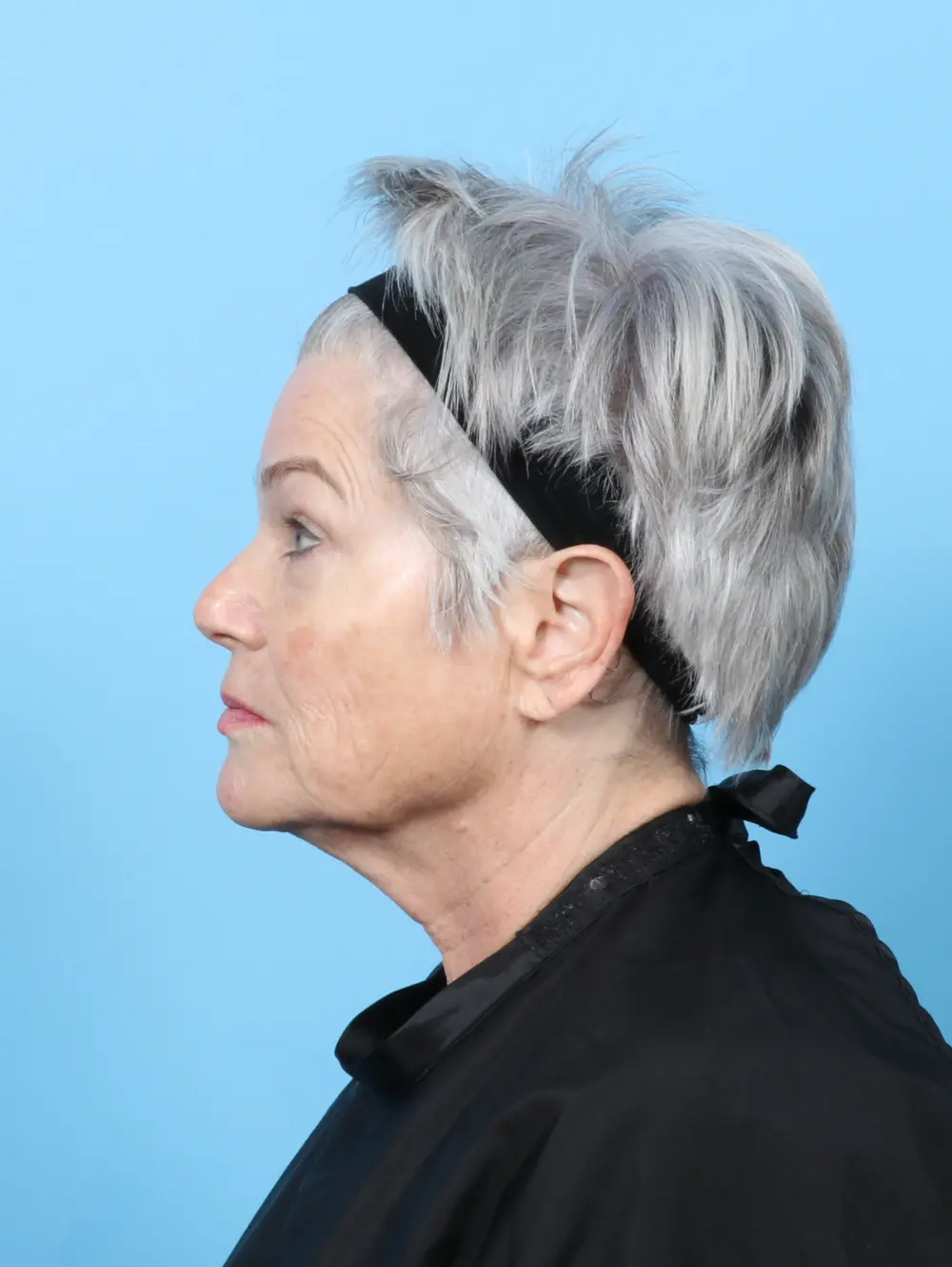 Facelift / Neck Lift Patient Photo - Case 59405 - before view-2