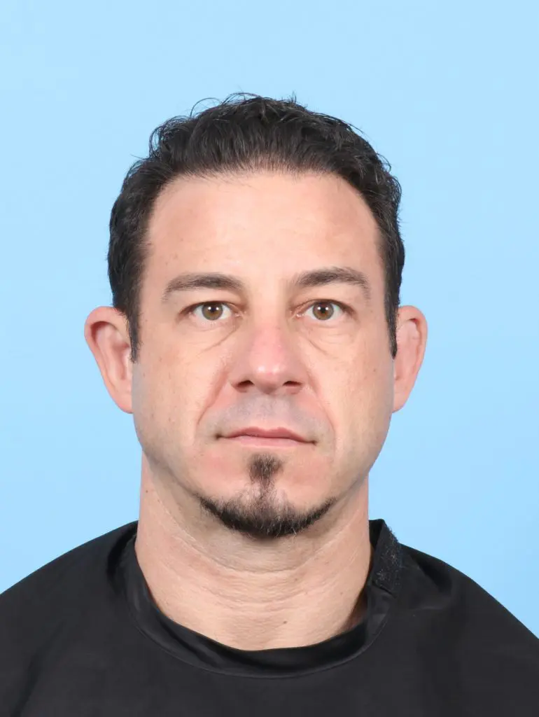 Eyelid Surgery - Case 59432 - Before