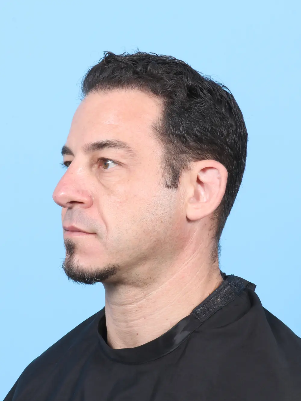 Eyelid Surgery Patient Photo - Case 59432 - before view-1