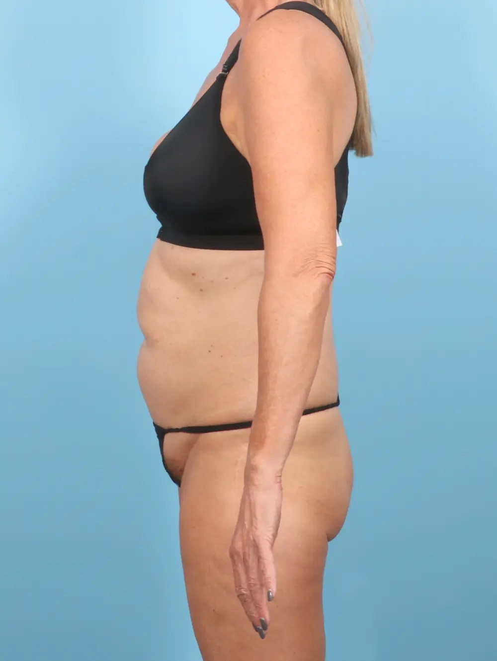 Tummy Tuck Patient Photo - Case 59440 - before view-2