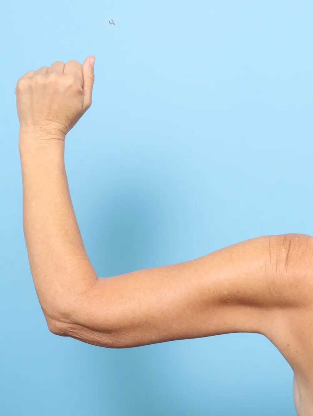 Arm Lift Patient Photo - Case 59448 - after view-1