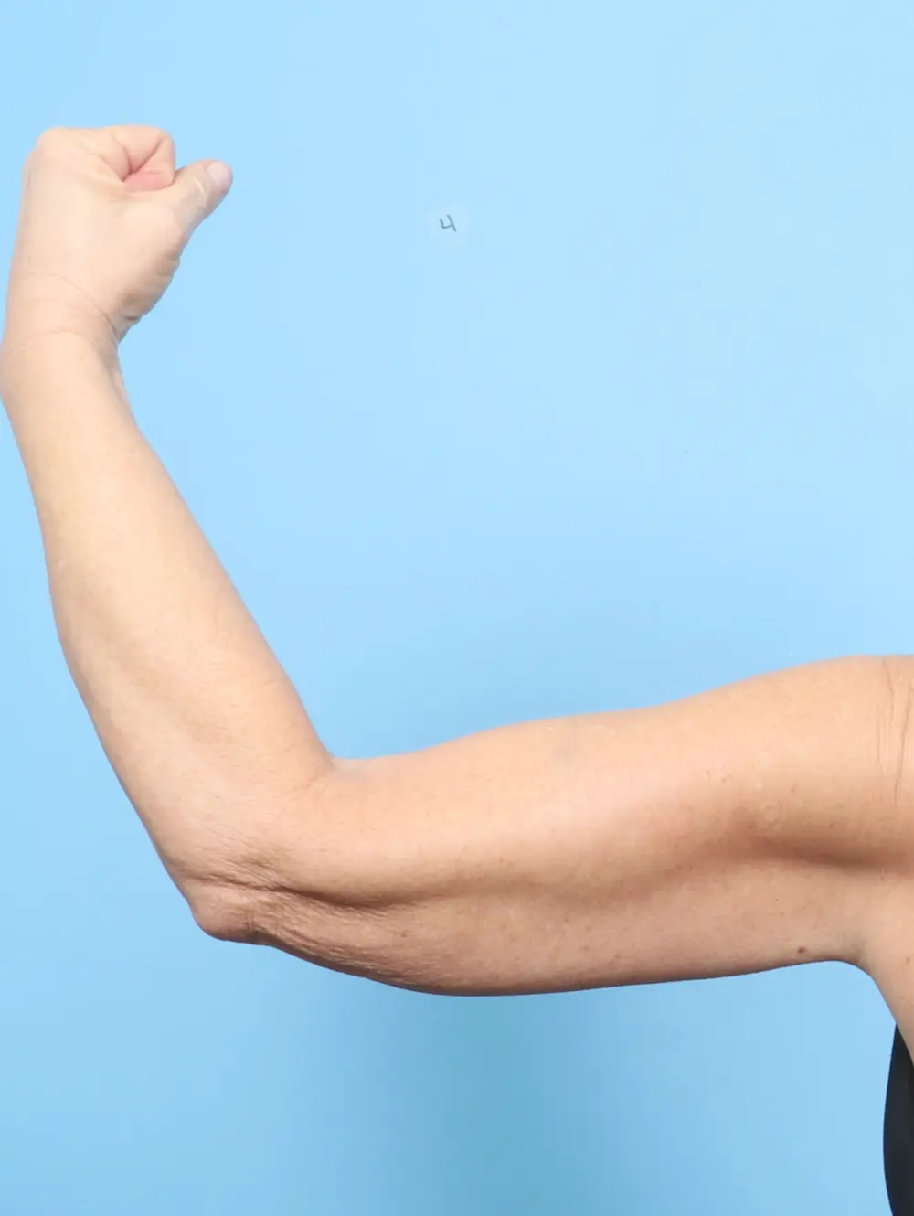 Arm Lift Patient Photo - Case 59448 - before view-1