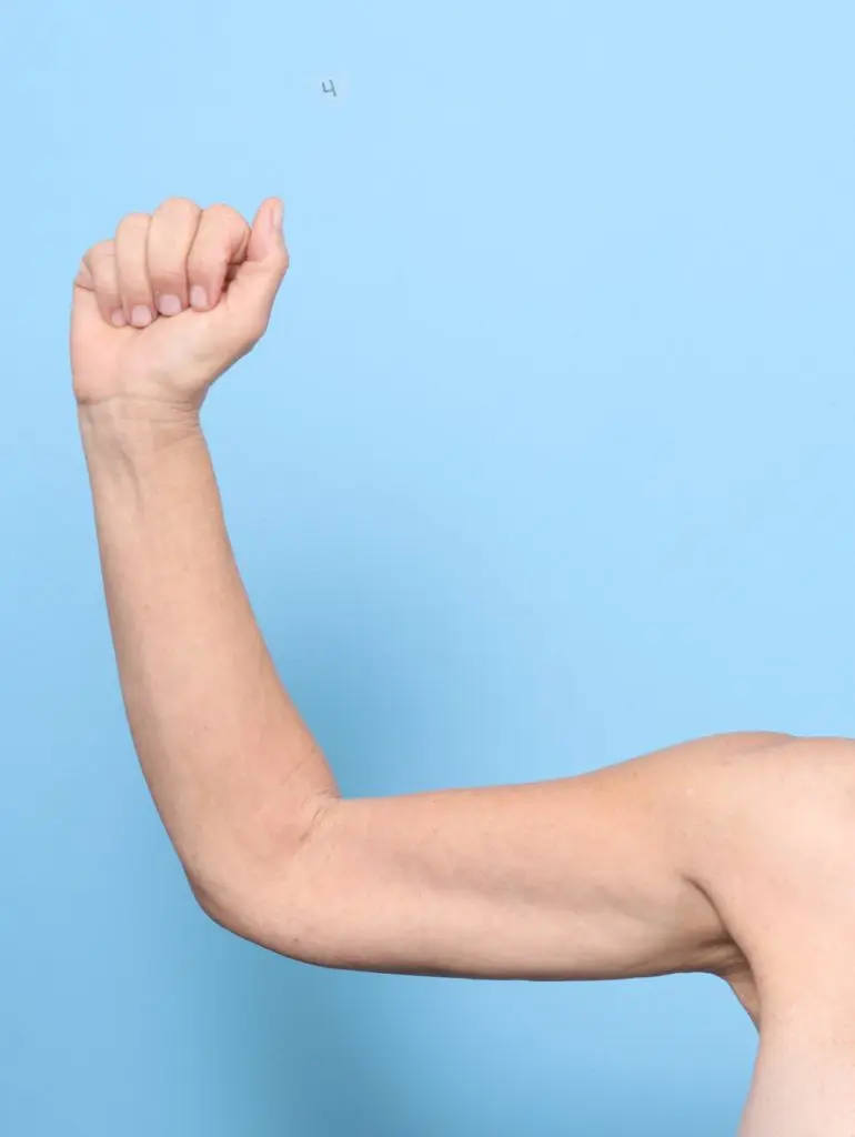 Arm Lift - Case 59448 - After