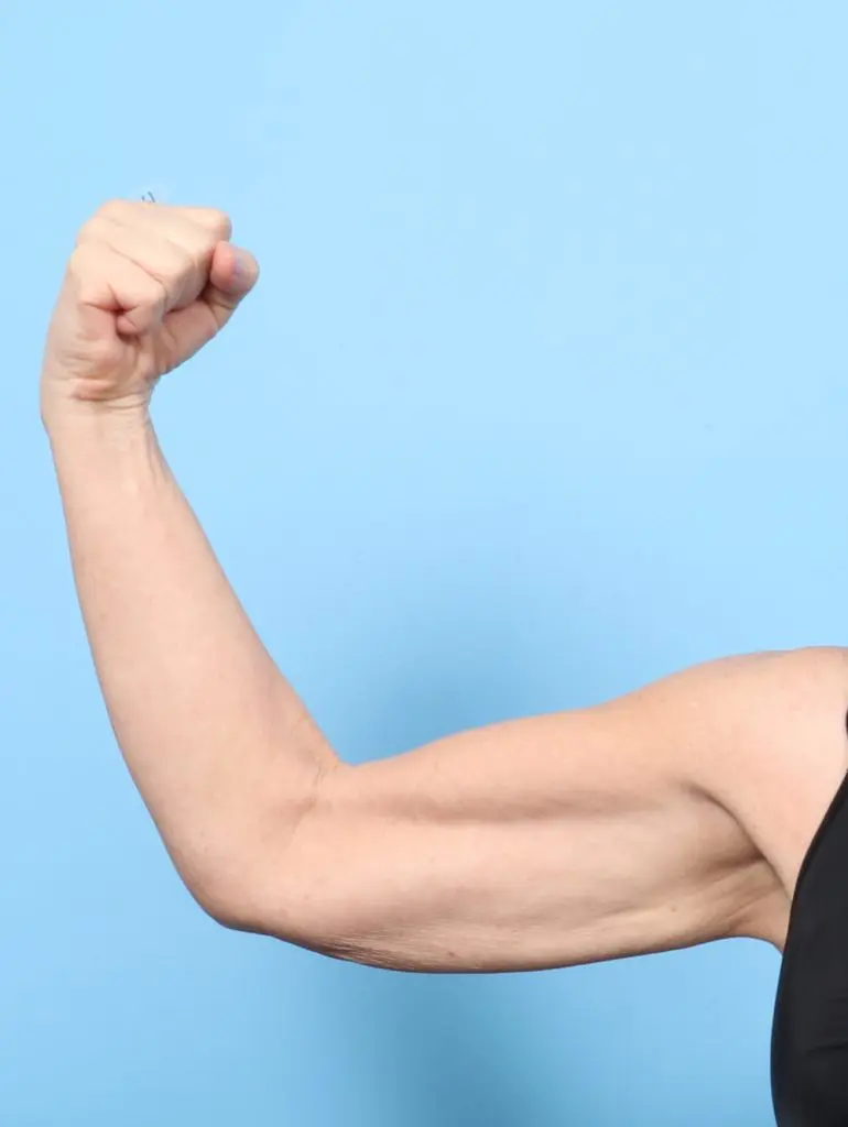 Arm Lift - Case 59448 - Before