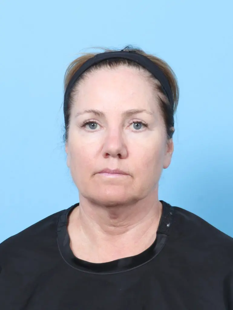 Eyelid Surgery - Case 59454 - After