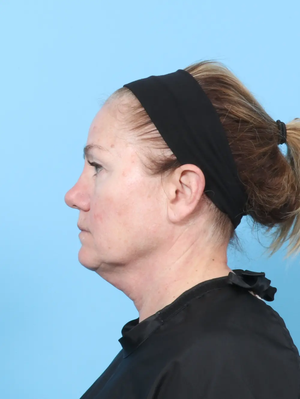 Eyelid Surgery Patient Photo - Case 59454 - before view-2