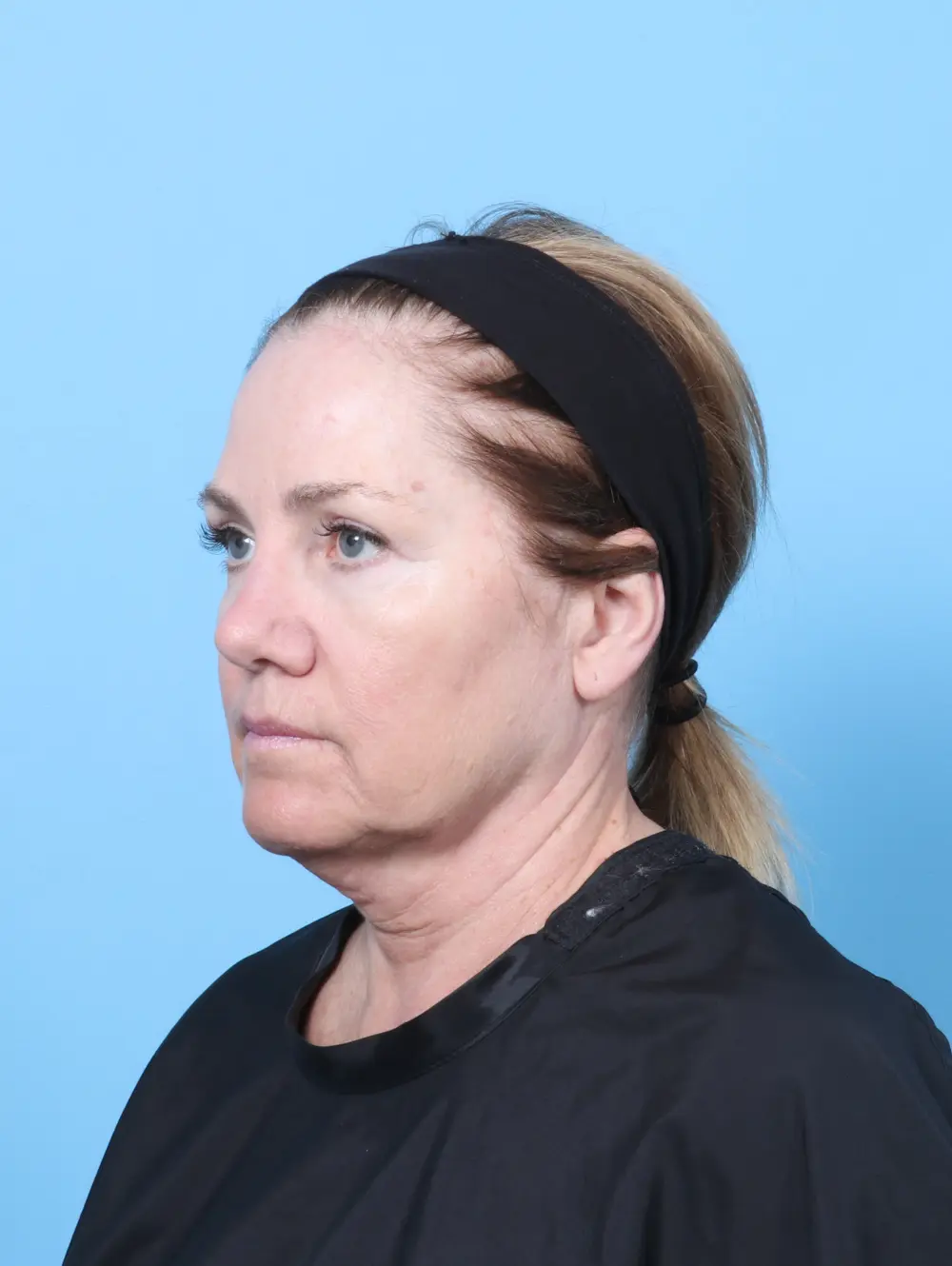 Eyelid Surgery Patient Photo - Case 59454 - after view-1