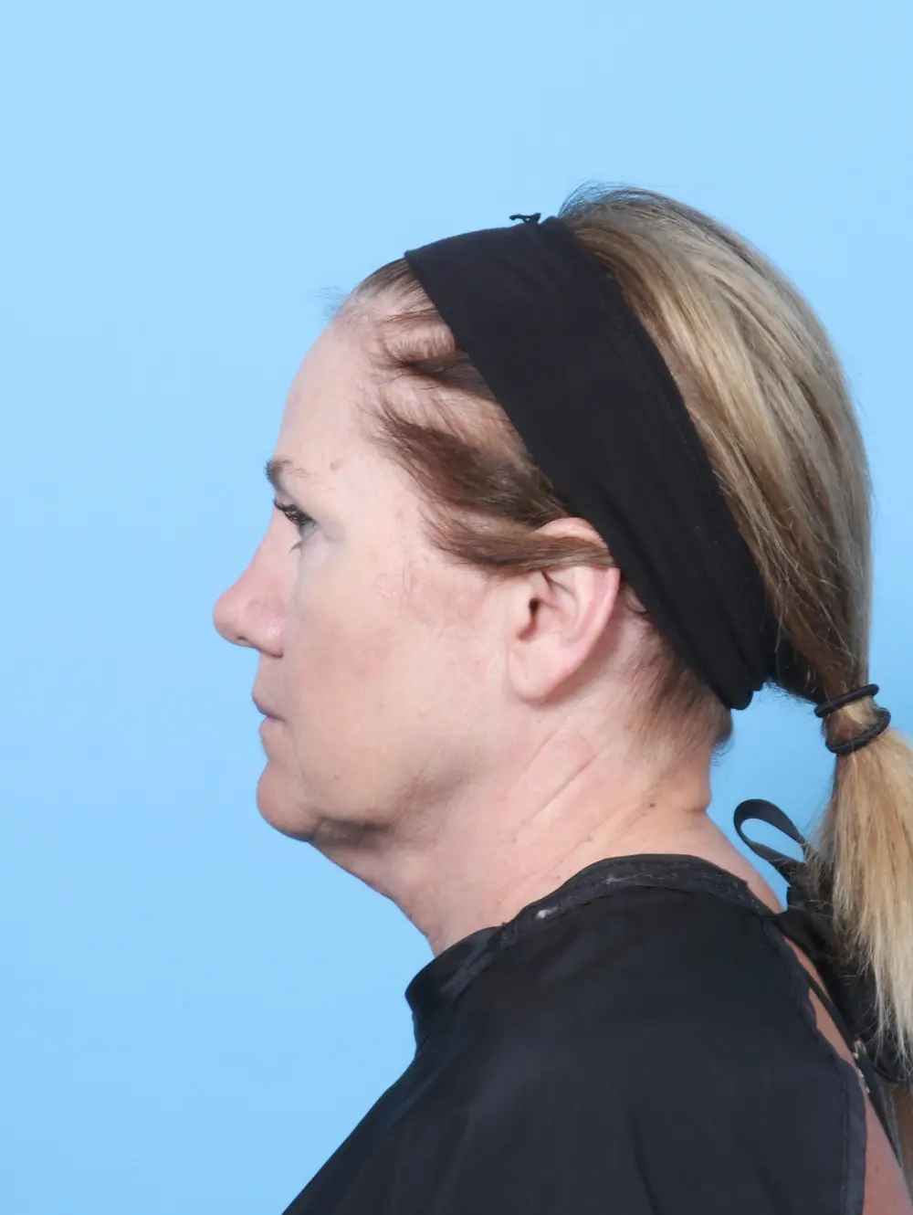 Eyelid Surgery Patient Photo - Case 59454 - after view-2