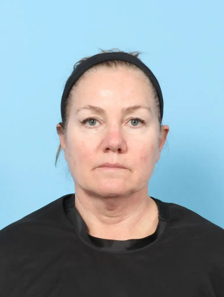 Eyelid Surgery - Case 59454 - Before