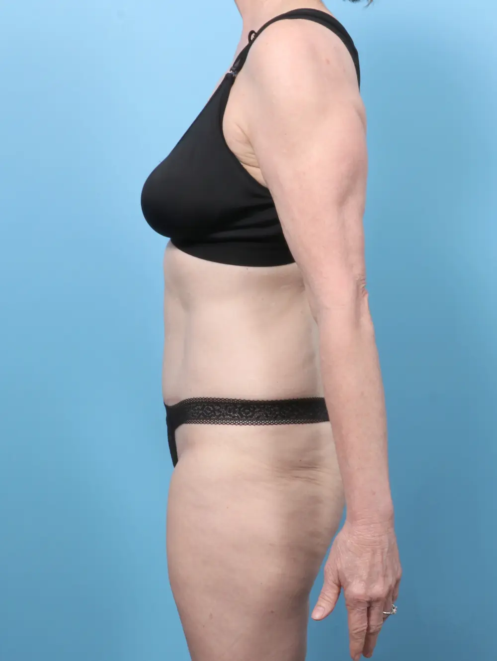 Tummy Tuck Patient Photo - Case 59462 - after view-2