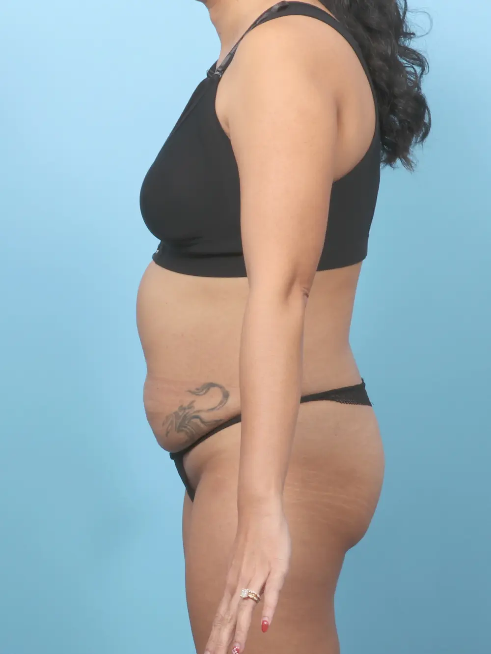 Tummy Tuck Patient Photo - Case 59478 - before view-2