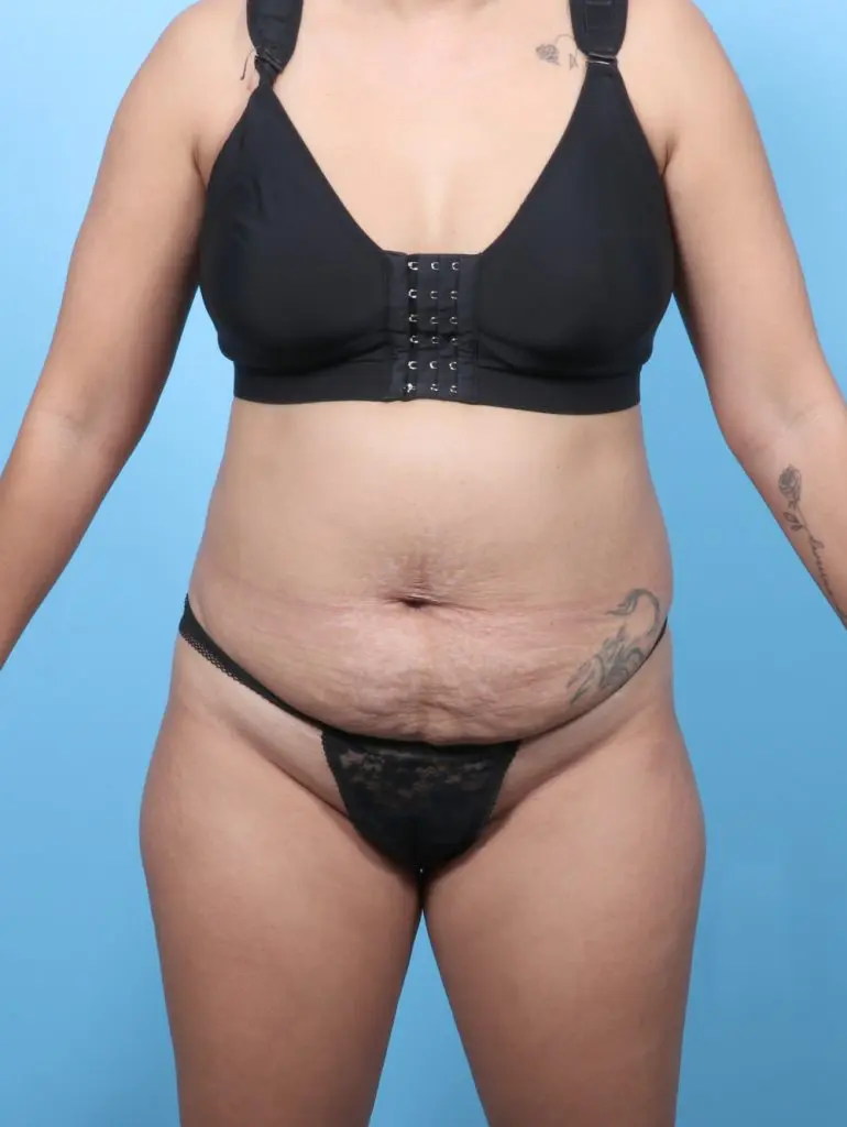 Tummy Tuck - Case 59478 - Before