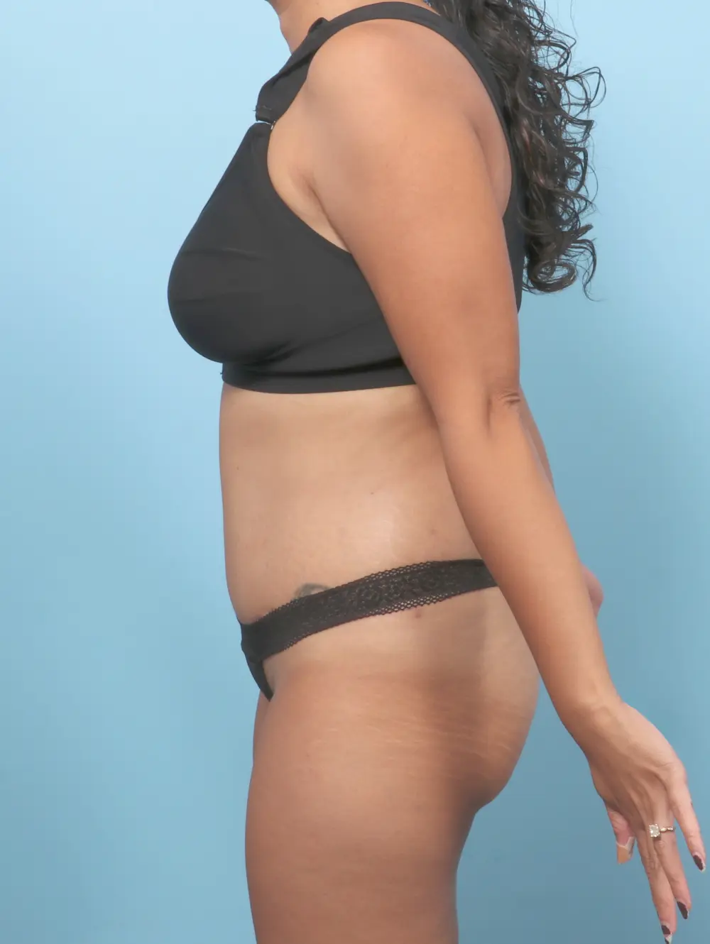 Tummy Tuck Patient Photo - Case 59478 - after view-2