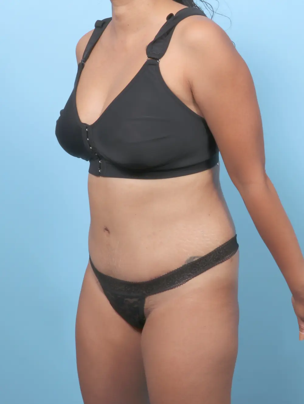 Tummy Tuck Patient Photo - Case 59478 - after view-1