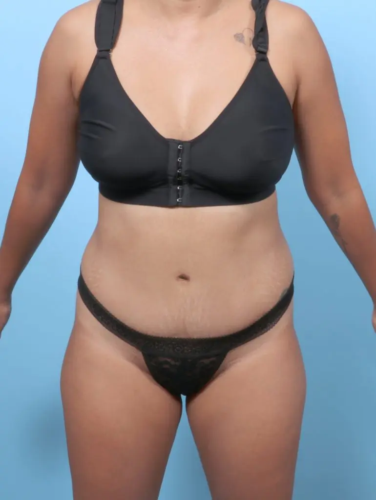 Tummy Tuck - Case 59478 - After