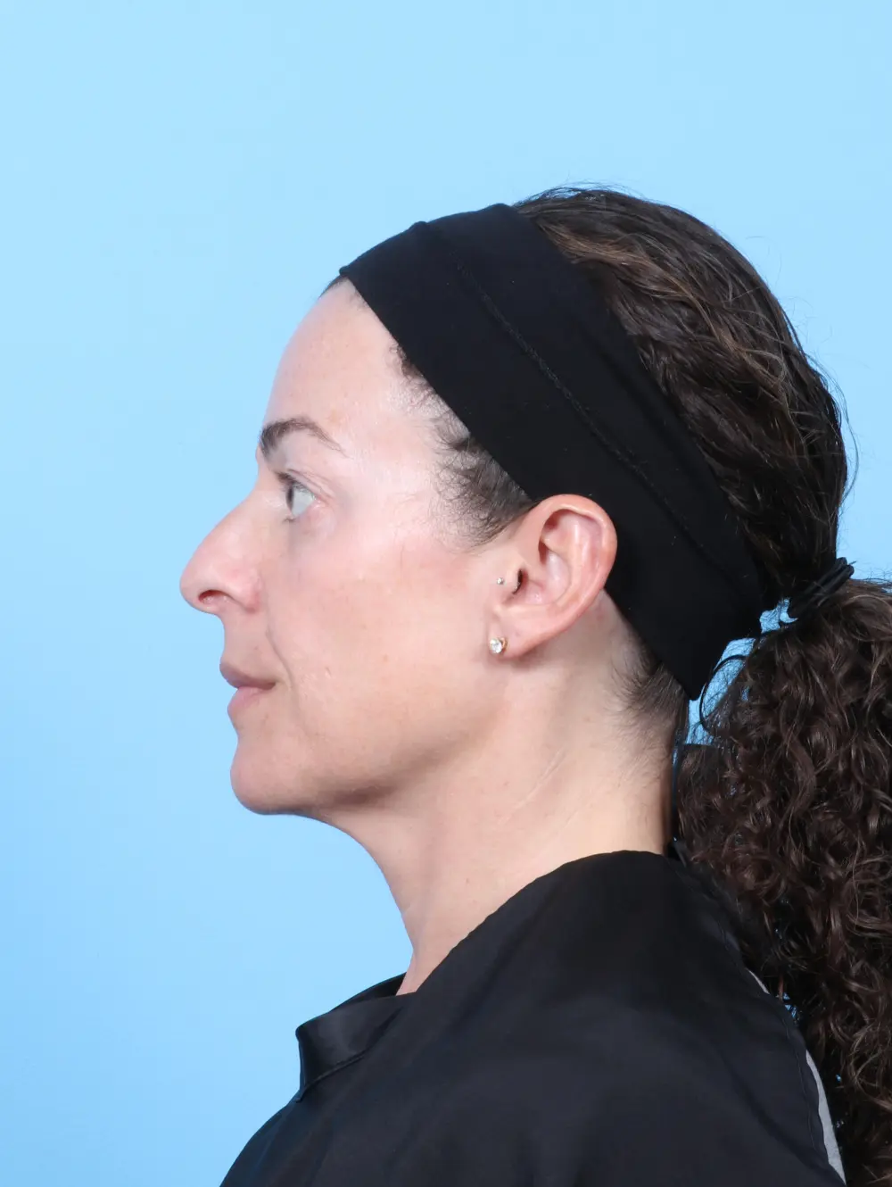 Eyelid Surgery Patient Photo - Case 59486 - before view-2