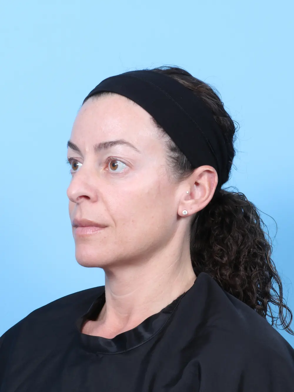Eyelid Surgery Patient Photo - Case 59486 - before view-1