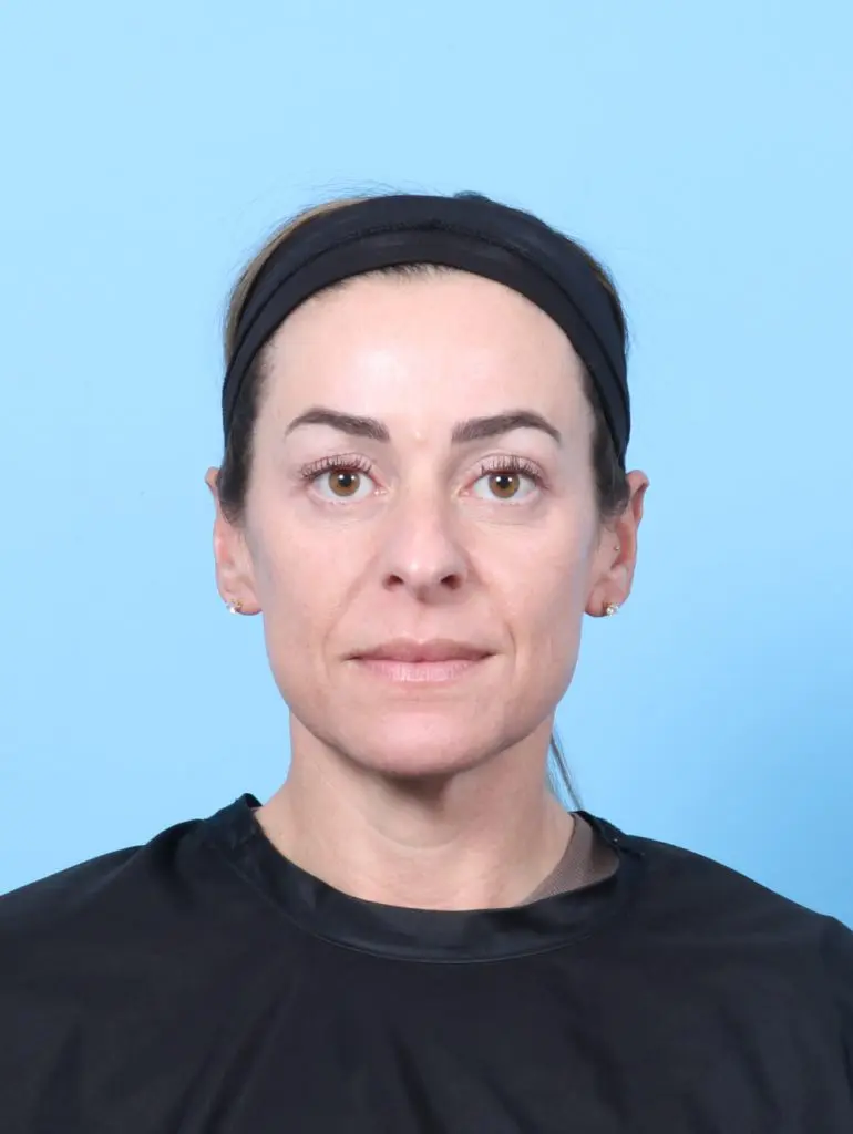 Eyelid Surgery - Case 59486 - After