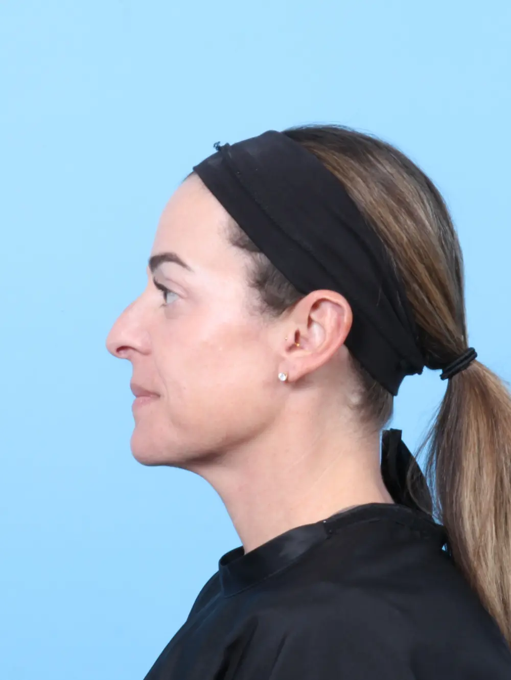 Eyelid Surgery Patient Photo - Case 59486 - after view-2