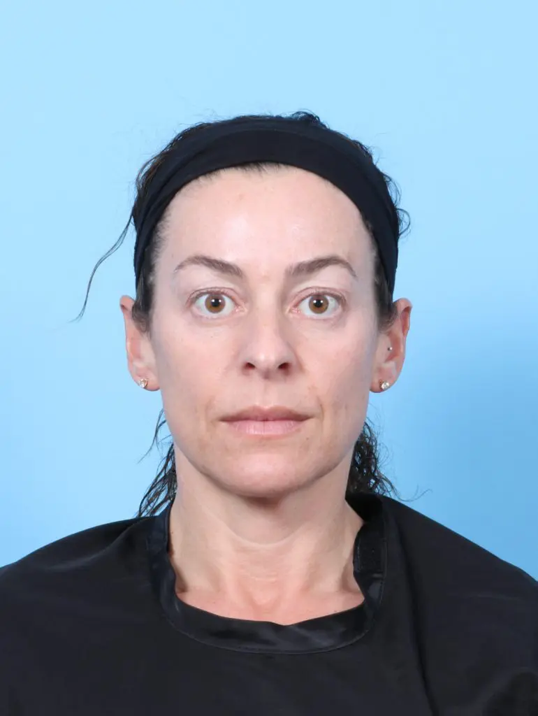 Eyelid Surgery - Case 59486 - Before