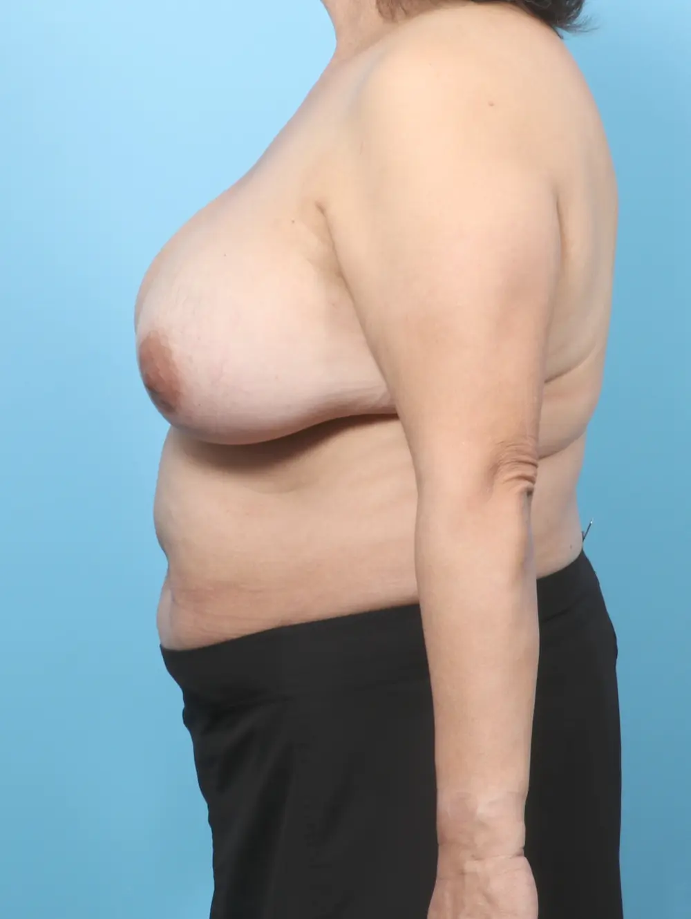 Breast Implant Removal Patient Photo - Case 59532 - before view-2